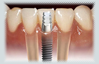 Implantologie - Implant dentar